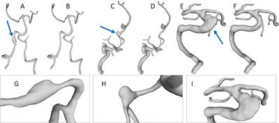 Can Endovascular Treatment of Fusiform Intracranial Aneurysms Restore the Healthy Hemodynamic Environment?–A Virtual Pilot Study